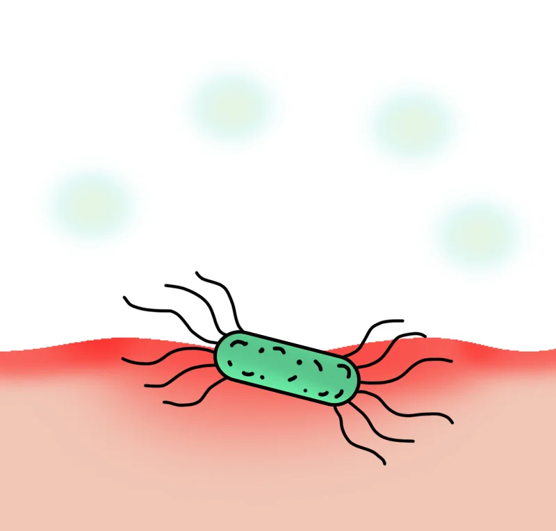 Thinning lining, bacteria present, early
inflammation visible