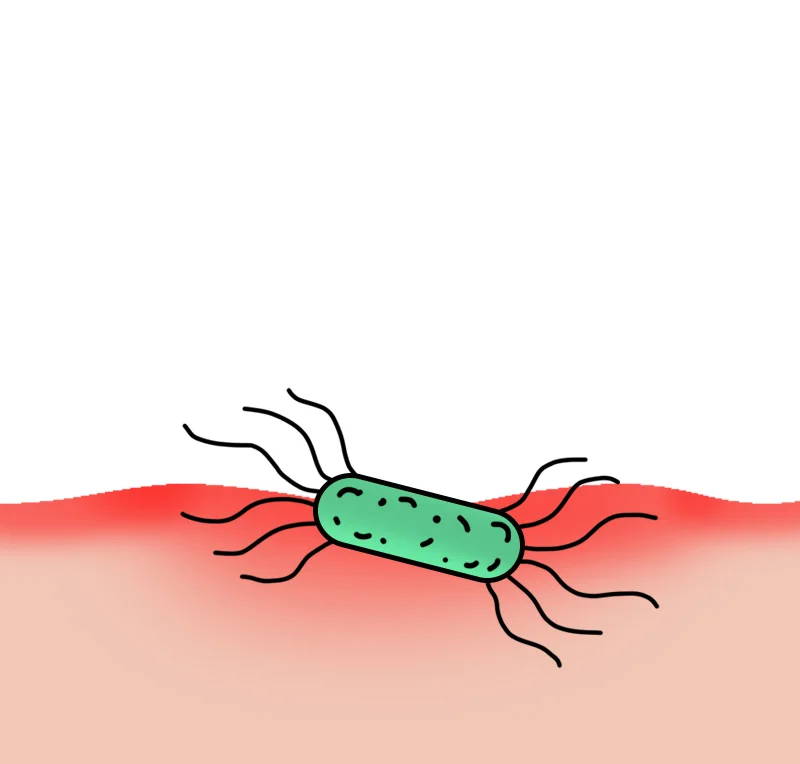 Severely thinned lining, widespread
inflammation, acid exposure