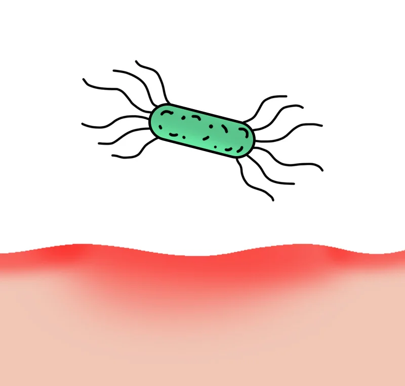 Bacteria gone, but lining still thin and damaged